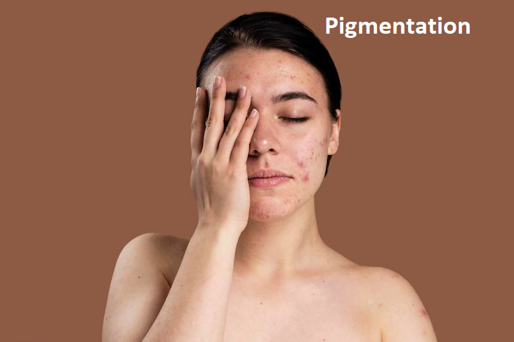 Pigmentation: Types, Causes, Symptoms, Tips & Home Remedies