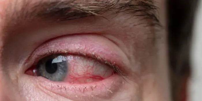 Conjunctivitis: Causes, Tips & Home Remedies