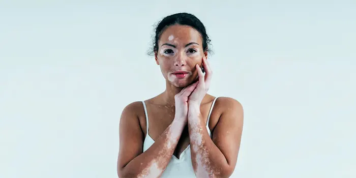 Vitiligo: Causes, Tips & Home Remedies 